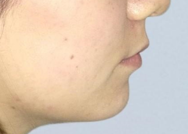 20代女性 ワイヤー矯正と矯正用ネジを併用して口元の突出感を改善した症例 画像
