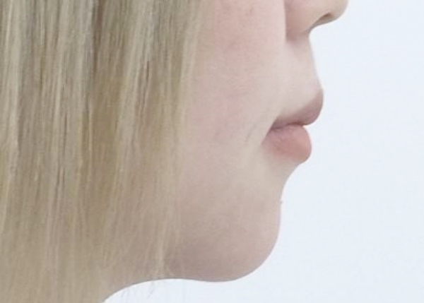 20代女性 アンカースクリューを活用して前歯の叢生・口元の前突感・口ゴボを改善し、特に下あごのオートローテーションによりあご先の位置を整えた症例 画像