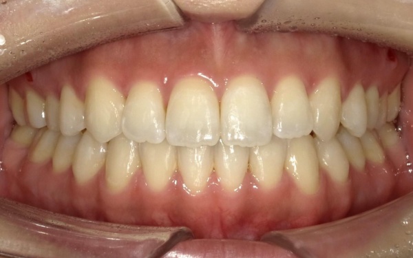 20代女性 「マルチブラケット装置」と矯正治療用のネジを併用して前歯のオープンバイトを非抜歯で改善した症例 画像