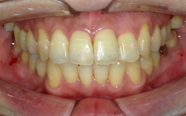 20代女性 重度の叢生を小臼歯の抜歯を避けワイヤー矯正で正常な噛み合わせに導いた症例 画像